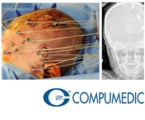 Epilepsi cerrahisinde Video EEG ve elektrod uygulaması